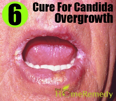 candida overgrowth cure natural findhomeremedy