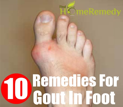 Gout Foot Stock Photos Images. Royalty Free Gout Foot ...