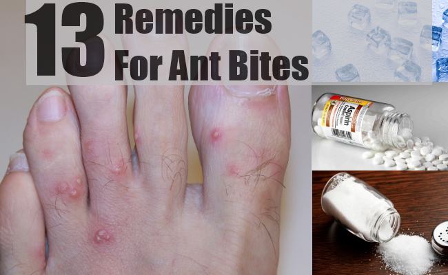 How to Treat a Fire Ant Sting: 14 Steps (with Pictures ...