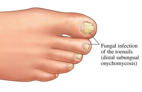 Cure Toenail Fungus Toenail fungus can distort and destroy toenail,