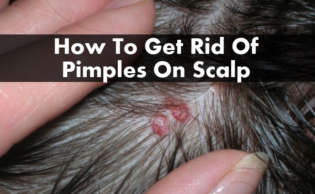 How To Get Rid Of Pimples On Scalp | Find Home Remedy ...