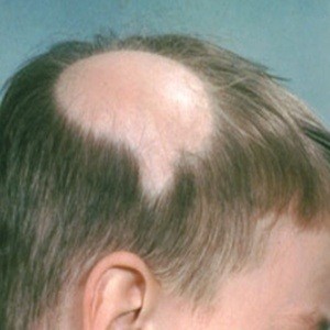 Tips to cure alopecia naturally