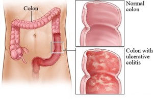 Cure colitis