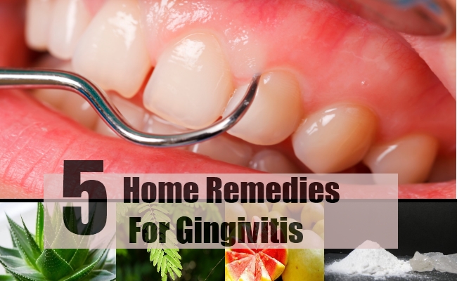Gingivitis Gingivitis