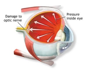 Cure glaucoma