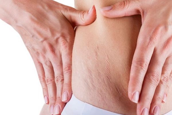 Remedies For Stretch Marks