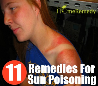 Sun Poisoning Sun Poisoning