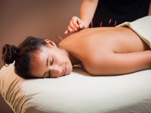 Acupuncture Acupuncture