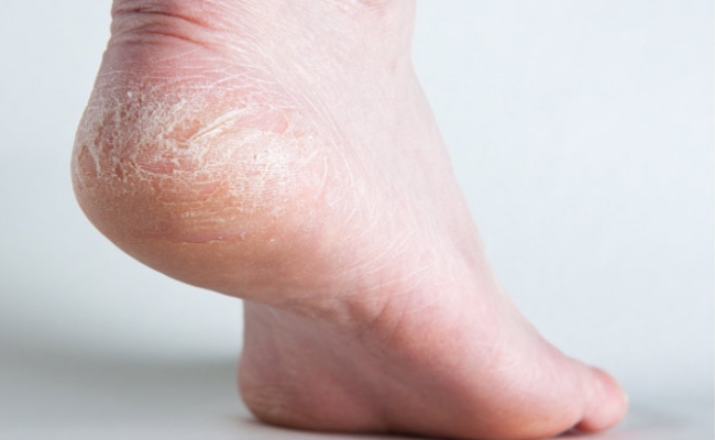Cracked Heels Cracked Heels