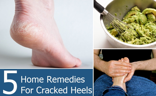 Home Remedies For Cracked Heels Home Remedies For Cracked Heels