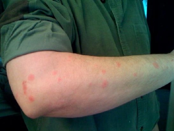Remedy for Bug bites