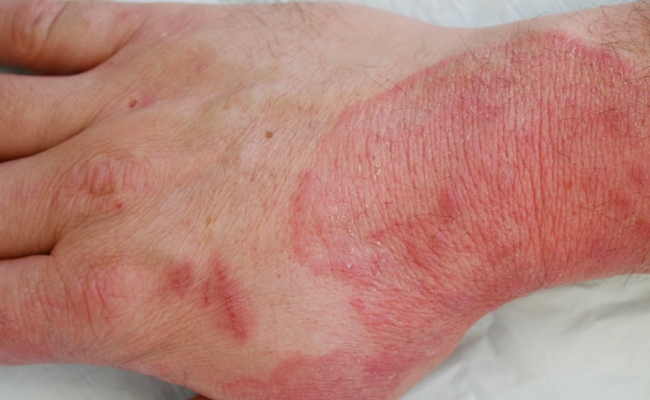 Fungal infections (2)