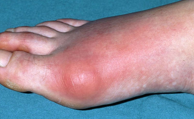 Prevent Gout Prevent Gout