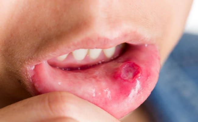 Heals Canker Sores Heals Canker Sores