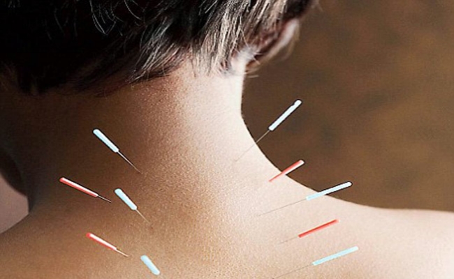 Acupuncture (2)