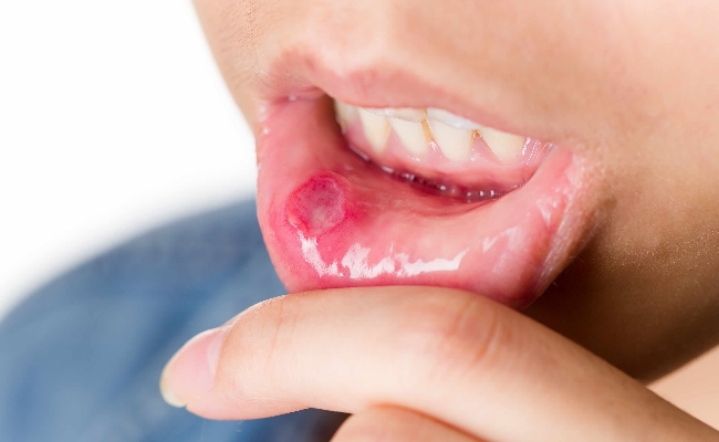 Helps Treat Cold Sores And Mouth Ulcers Helps Treat Cold Sores And Mouth Ulcers