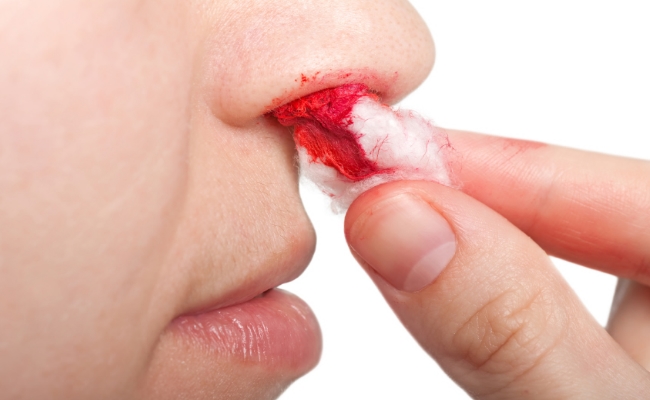 nose bleeding