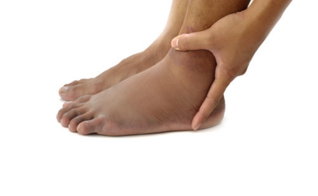 swelling swelling