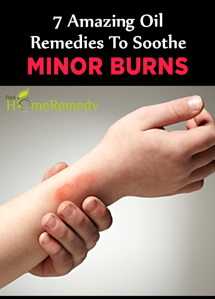 7 Amazing Oil Remedies To Soothe Minor Burns 7 Amazing Oil Remedies To Soothe Minor Burns