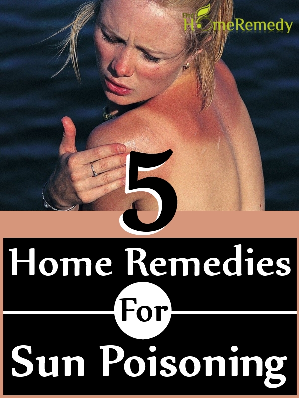 Home Remedies For Sun Poisoning