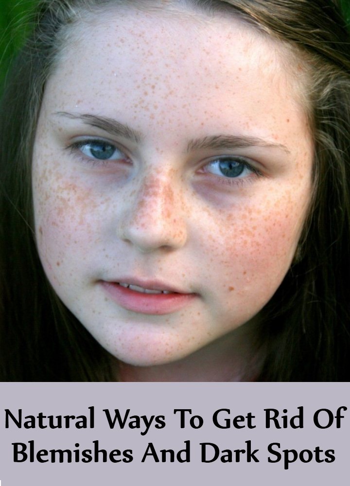 Natural Ways To Get Rid Of Blemishes And Dark Spots