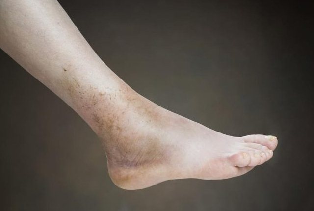Swelling Swelling